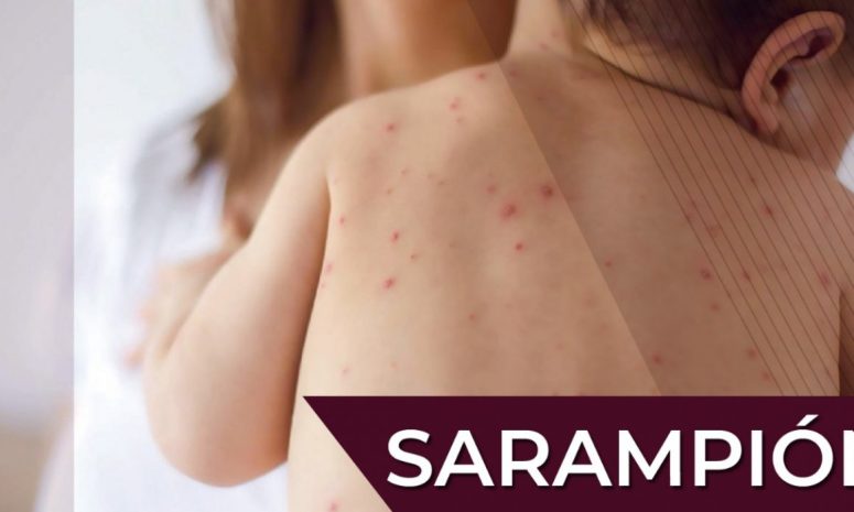 Suman 362 casos de sarampión y un fallecido en México en el año