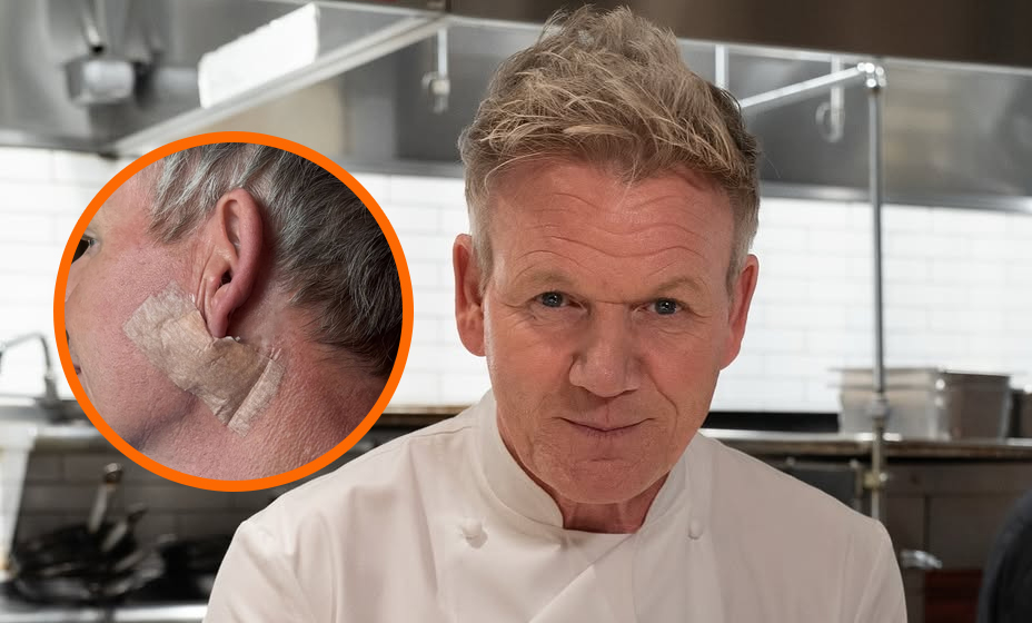Comparte el chef Gordon Ramsay su diagnóstico de cáncer de piel ...